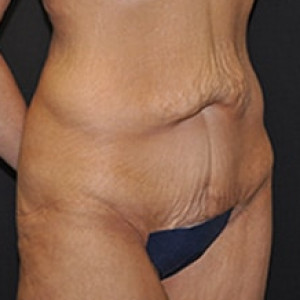 Before Image: Case #3933 – Tummy Tuck - right-front-oblique