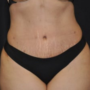 After Image: Case #4570 – Tummy Tuck - front