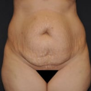 Before Image: Case #4570 – Tummy Tuck - front