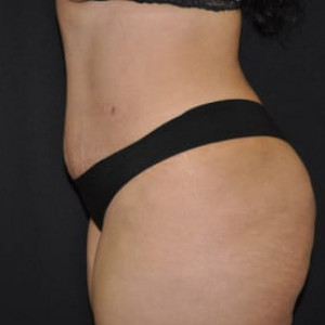 After Image: Case #4570 – Tummy Tuck - other