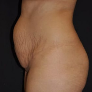 Before Image: Case #4570 – Tummy Tuck - other