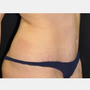 After Image: Case #3610 – Tummy Tuck - right-front-oblique