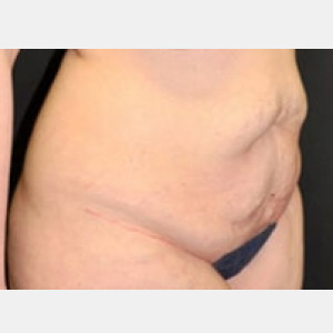 Case #3610 – Tummy Tuck