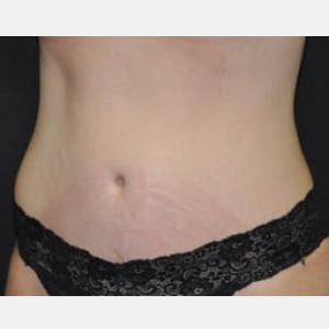 After Image: Case #4259 – Tummy Tuck - left-front-oblique