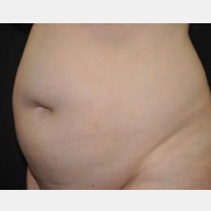 Case #4259 – Tummy Tuck