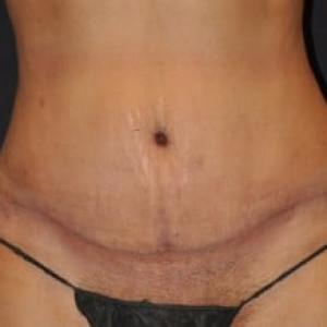 After Image: Case #4142 – Tummy Tuck - front