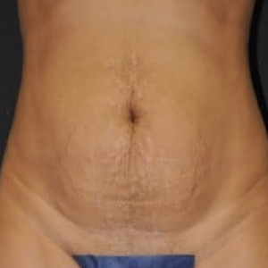 Before Image: Case #4142 – Tummy Tuck - front