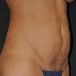 Before Image: Case #4142 – Tummy Tuck - right-front-oblique