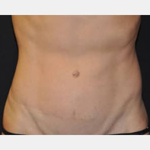 After Image: Case #5483 – Tummy Tuck - front