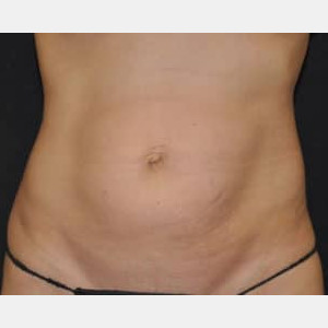 Before Image: Case #5483 – Tummy Tuck - front