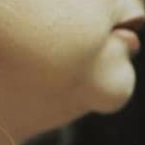 Before Image: Case #2531 – Liposuction - other