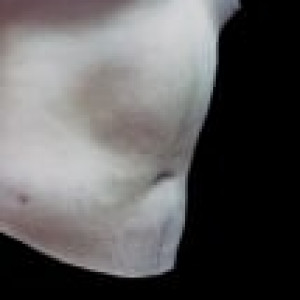 After Image: Case #2518 – Liposuction - right-front-oblique