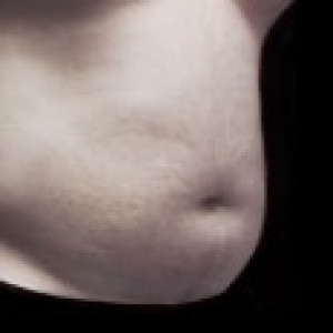 Before Image: Case #2518 – Liposuction - right-front-oblique