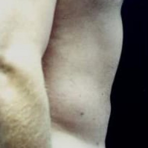 After Image: Case #2518 – Liposuction - other