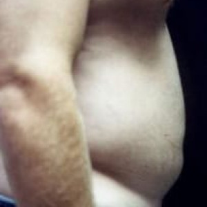 Before Image: Case #2518 – Liposuction - other