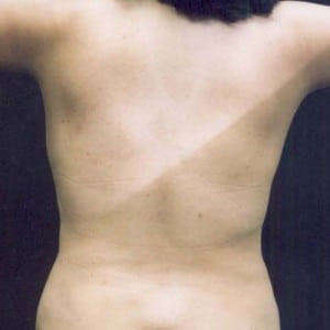 After Image: Case #2515 – Liposuction - back