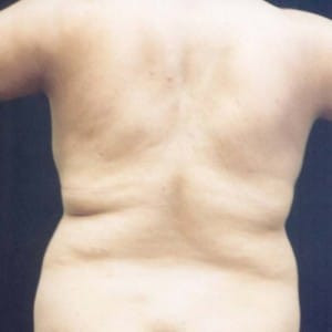 Before Image: Case #2515 – Liposuction - back