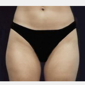 Case #2507 – Liposuction