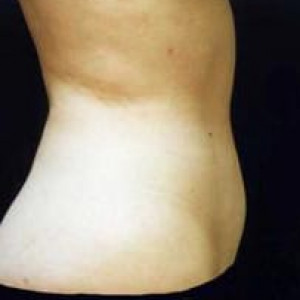 After Image: Case #2494 – Liposuction - other