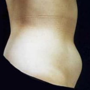 Case #2494 – Liposuction