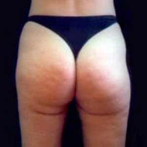 After Image: Case #2497 – Liposuction - back