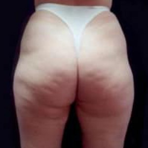 Before Image: Case #2497 – Liposuction - back