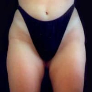 After Image: Case #2497 – Liposuction - front