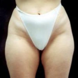 Before Image: Case #2497 – Liposuction - front
