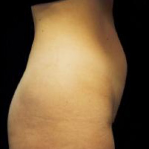 Case #2489 – Liposuction