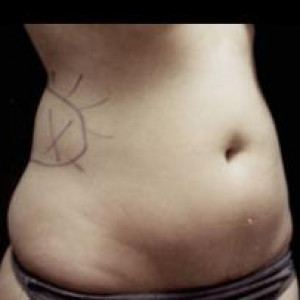 Case #2484 – Liposuction