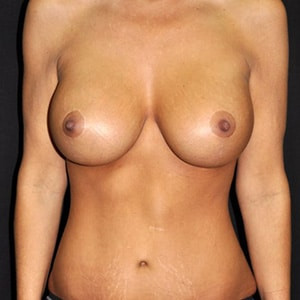 After Image: Case #3586 – Total Body Contouring - front
