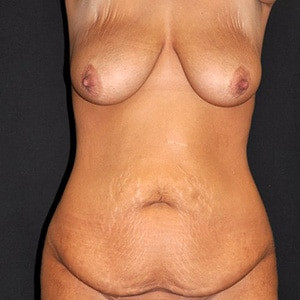 Before Image: Case #3586 – Total Body Contouring - front