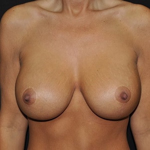 After Image: Case #2612 – Total Body Contouring - front