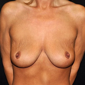 Before Image: Case #2612 – Total Body Contouring - front