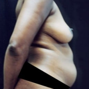 Before Image: Case #0128 – Total Body Contouring - other