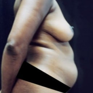 Before Image: Case #0135 – Mommy Makeover - right-front-oblique