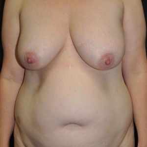 Before Image: Case #4251 – Mommy Makeover - front