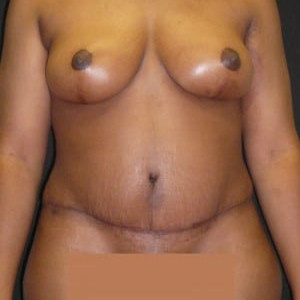 After Image: Case #4127 – Mommy Makeover - front