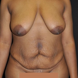 Before Image: Case #4127 – Mommy Makeover - front