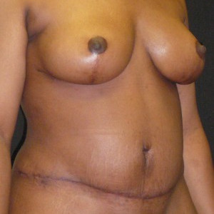 After Image: Case #4127 – Mommy Makeover - right-front-oblique