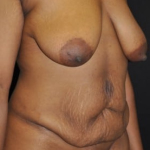 Before Image: Case #4127 – Mommy Makeover - right-front-oblique