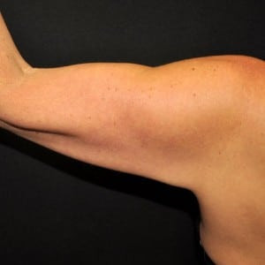 Before Image: Case #3700 – Arm Lift - left-side