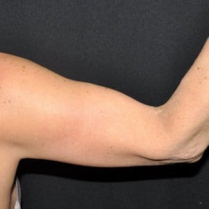 After Image: Case #3700 – Arm Lift - right-side