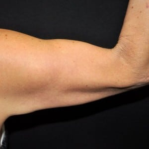 Before Image: Case #3700 – Arm Lift - right-side