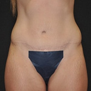 After Image: Case #3971 – Post Massive Weight Loss - front