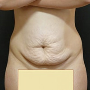 Before Image: Case #3971 – Post Massive Weight Loss - front