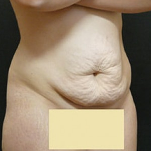 Before Image: Case #3971 – Post Massive Weight Loss - right-front-oblique