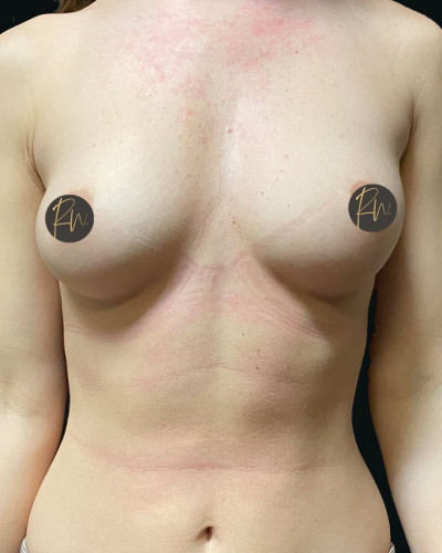 Before Image: Breast Augmentation - front
