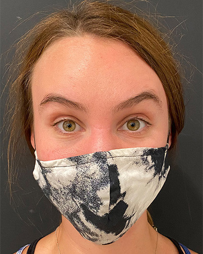 After Image: Case #5545 – Botox - front