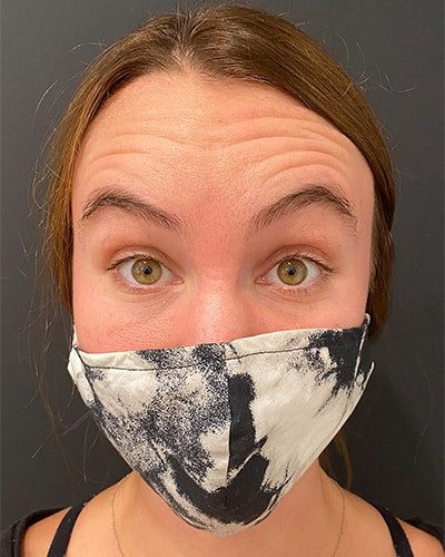 Before Image: Case #5545 – Botox - front